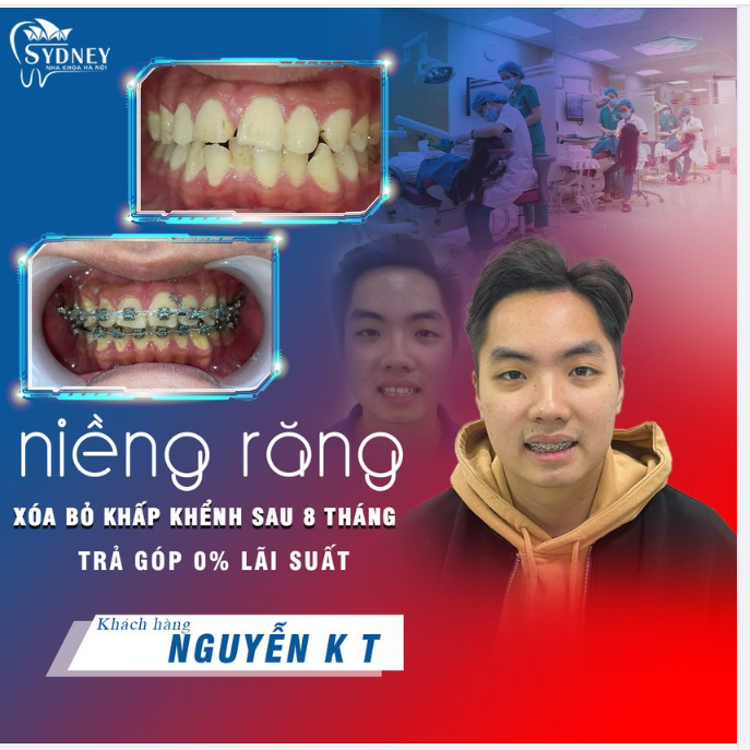 ĐẸP TRAI HƠN, TỰ TIN HƠN SAU 8 THÁNG GẮN MẮC CÀI