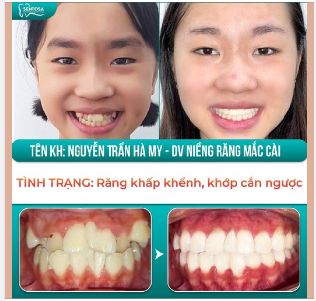Thời gian: 2 năm - Dịch vụ: Niềng răng Mắc cài - Tình trạng: Răng khấp khểnh, không đều, khớp cắn ngược