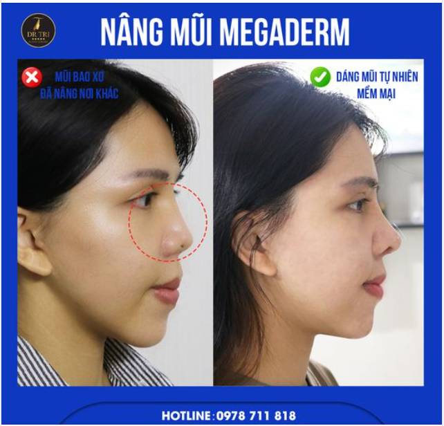 NÂNG MŨI MEGADERM => NÂNG TẦM NHAN SẮC