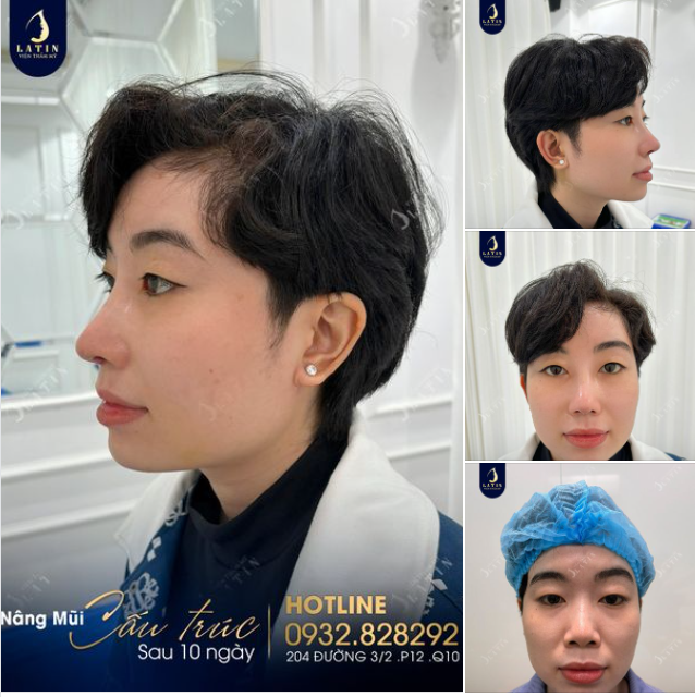 Tái khám, cắt chỉ sau 10 ngày nâng mũi, K.L vui mừng với dáng mũi mới quá hợp ý mình.