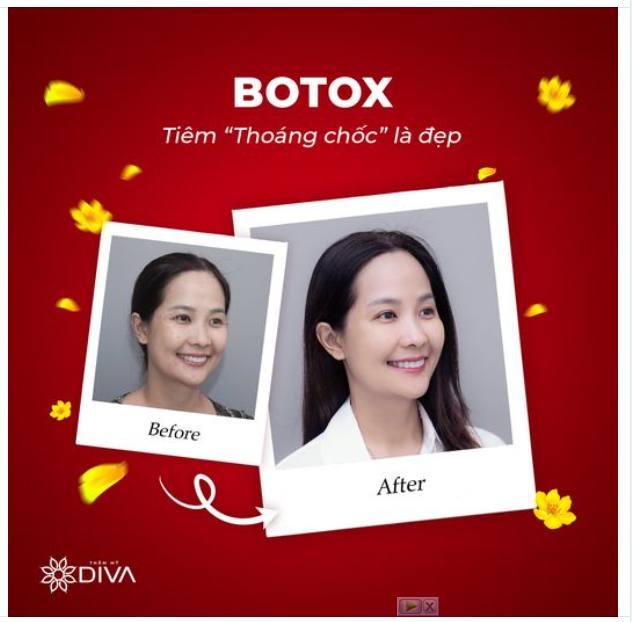 TIÊM BOTOX XÓA NHĂN TRẺ HÓA HIỆU QUẢ SAU 3 NGÀY THỰC HIỆN