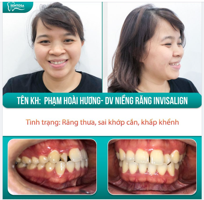 Ca niềng Invisalign cuối cùng của năm 2023!