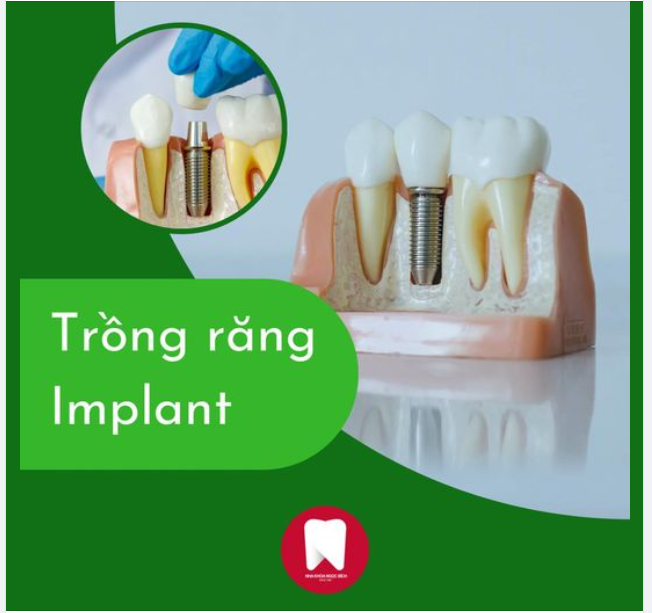5 LỢI ÍCH CỦA VIỆC TRỒNG IMPLANT