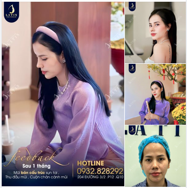 Mũi bán cấu trúc 1 tháng lên dáng sắc nét