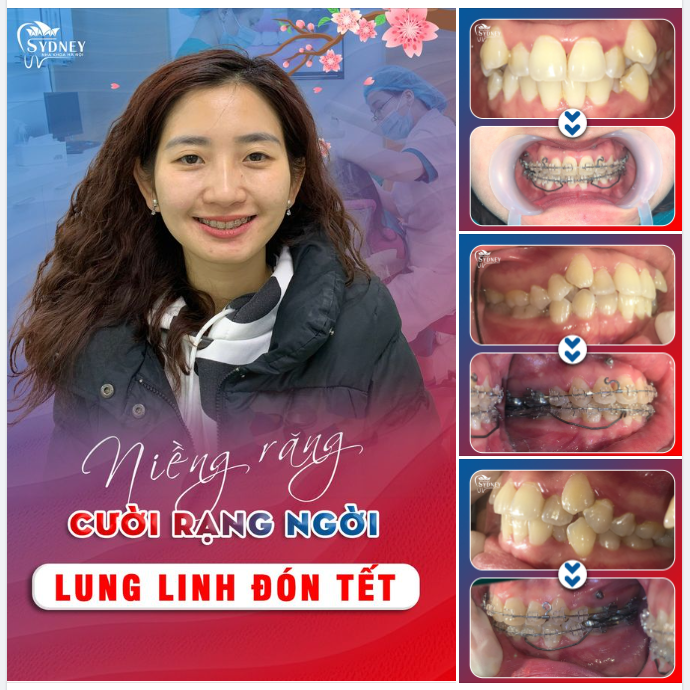 NIỀNG RĂNG - CƯỜI RẠNG NGỜI, LUNG LINH ĐÓN TẾT