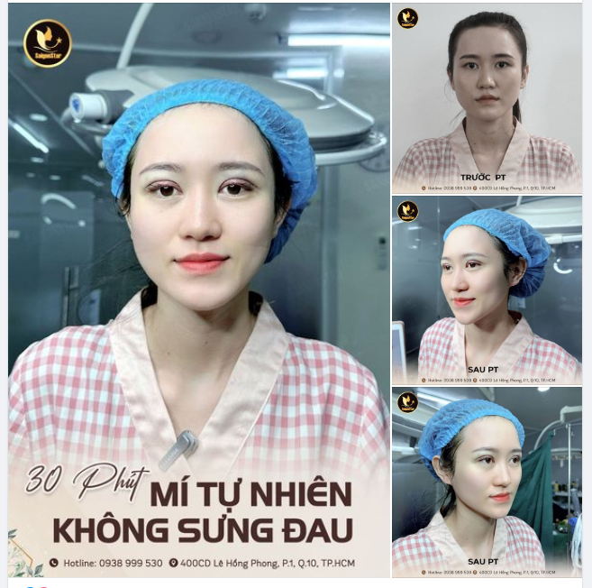 30 PHÚT NHẸ NHÀNG SỞ HỮU MÍ TỰ NHIÊN, KHÔNG SƯNG ĐAU