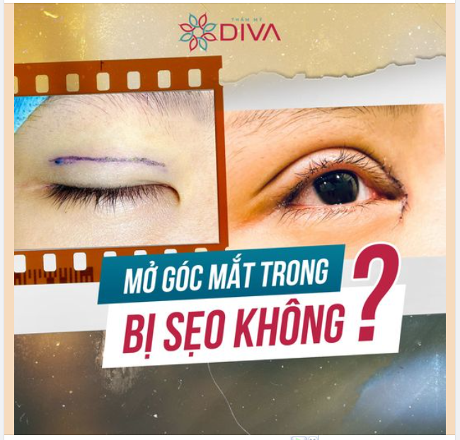 MỞ RỘNG GÓC MẮT CÓ ĐỂ LẠI SẸO