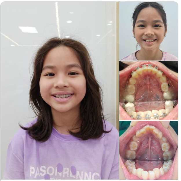 Cho con nụ cười toả nắng! Cho con góc nghiêng đẹp về: Phần mềm, răng, Xương.