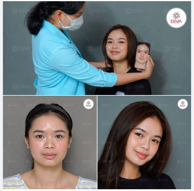 MŨI CAO TỰ NHIÊN, THU HÚT SAU 15 PHÚT NÂNG MŨI TINY POINT