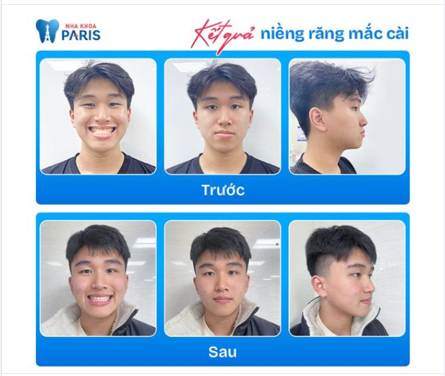 Kết quả mỹ mãn sau 24 tháng niềng răng