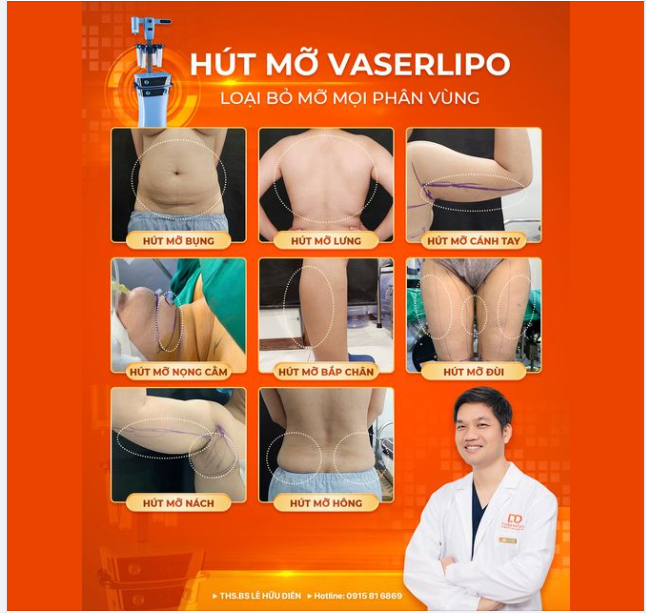 "HUỶ MỠ" MỌI PHÂN VÙNG THẬT DỄ DÀNG VỚI CÔNG NGHỆ HÚT MỠ VASERLIPO