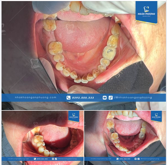 Răng hàm là răng chịu lực nhai rất lớn, đồng thời cũng giúp quá trình tiêu hóa diễn ra dễ dàng hơn.