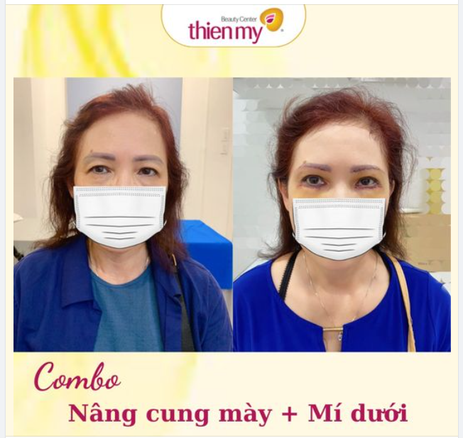 Các cách giảm sưng bầm hiệu quả khi PTTM: