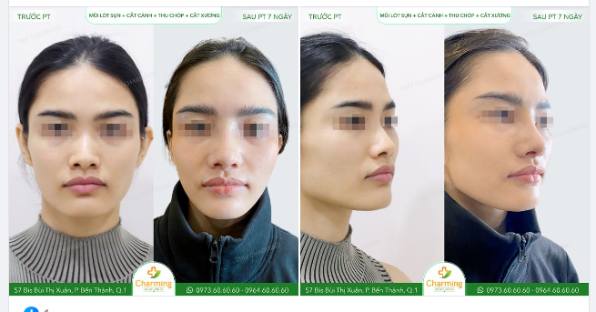 Chỉ trong một lần thực hiện phẫu thuật mà nàng khách đã có thể khắc phục được nhiều khuyết điểm ở vùng mũi.