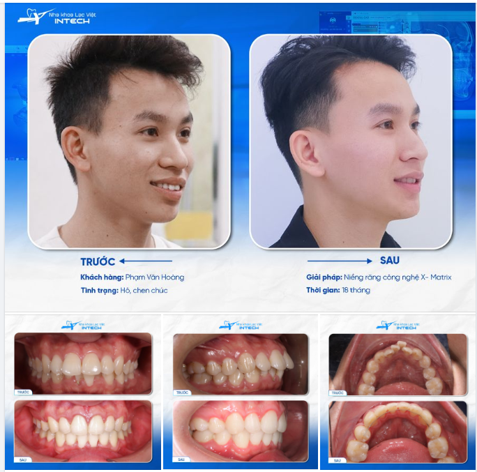 CHÀNG TRAI RĂNG HÔ THĂNG HẠNG ĐỘ ĐẸP TRAI NHỜ PHƯƠNG PHÁP NÀY