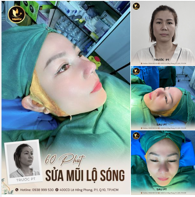 60 PHÚT SỬA MŨI LỘ SÓNG