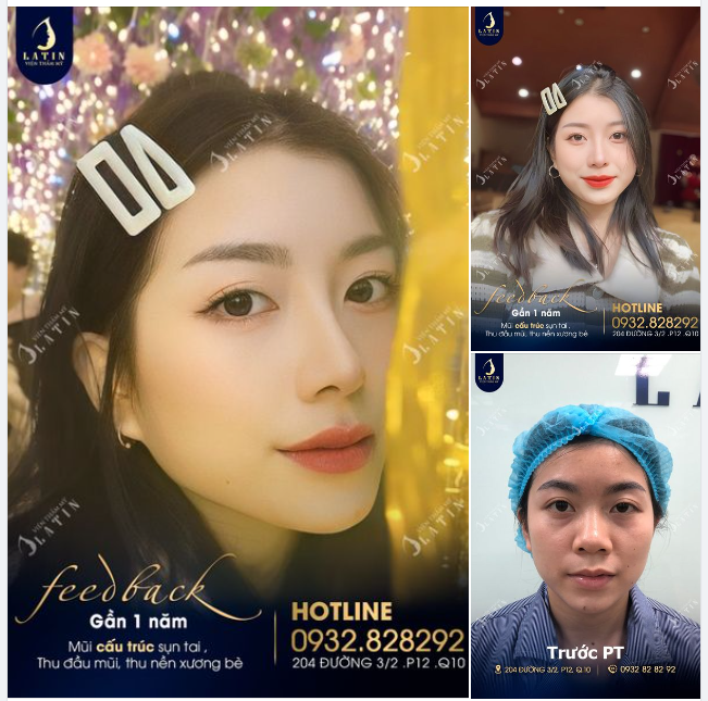 Chỉ thay đổi dáng mũi mới thôi mà nhan sắc và thần thái của em gái đã thay đổi hơn trước rất nhiều.