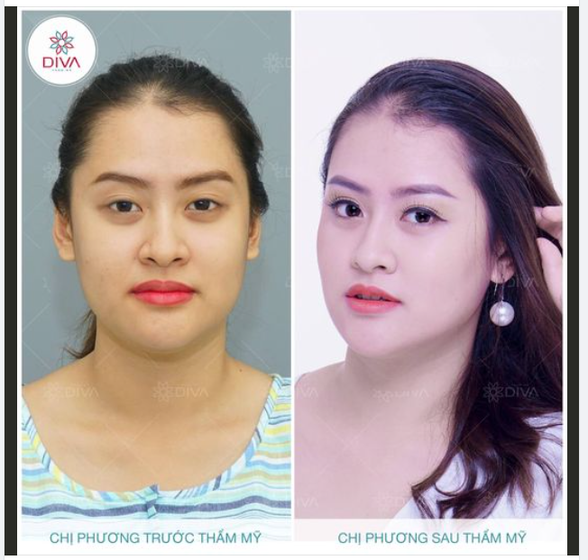 PHƯƠNG PHÁP TÁCH TÚI MỠ MÁ TRONG ĐƠN GIẢN HAY PHỨC TẠP?