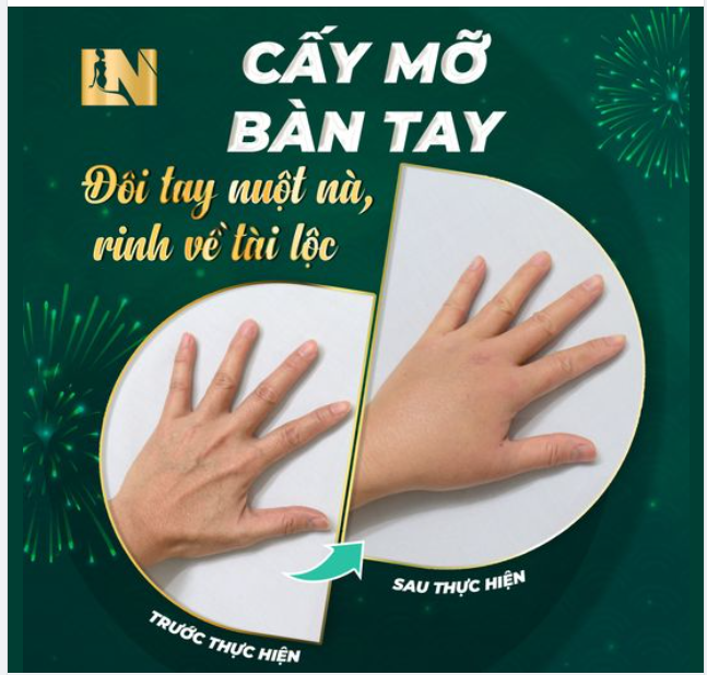 CẤY MỠ BÀN TAY, BÍ QUYẾT SỞ HỮU ĐÔI TAY NUỘT NÀ