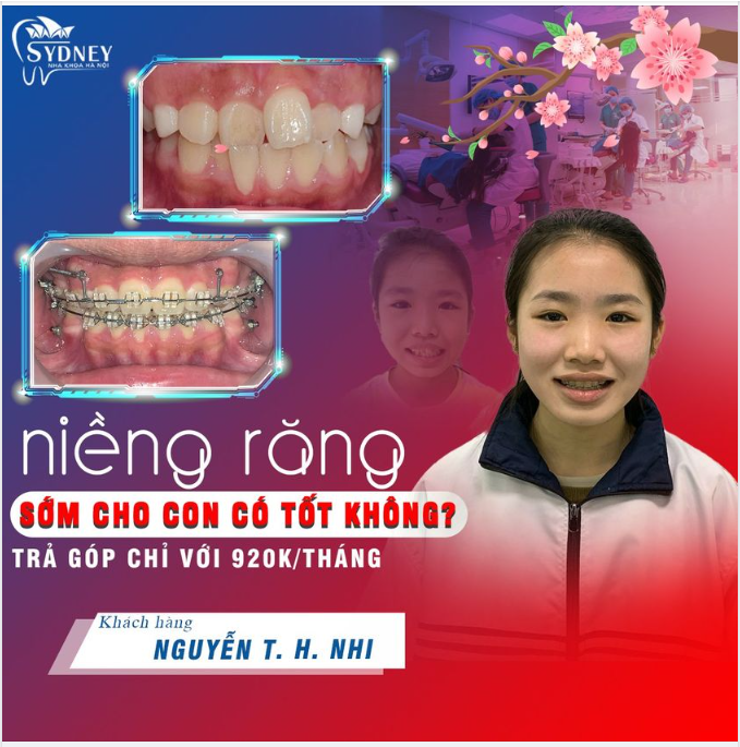NIỀNG RĂNG SỚM CHO CON CÓ TỐT KHÔNG?