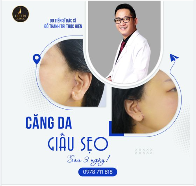 Bất ngờ với kết quả sau 3 ngày Căng Da Giấu Sẹo tại Dr.Trí