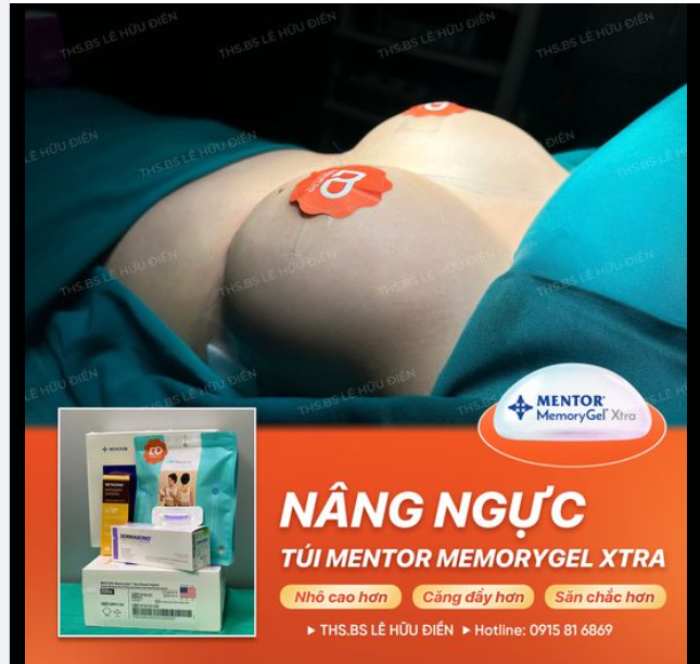 Nâng ngực MENTOR MEMORYGEL XTRA lên form xuất sắc ngay sau phẫu thuật