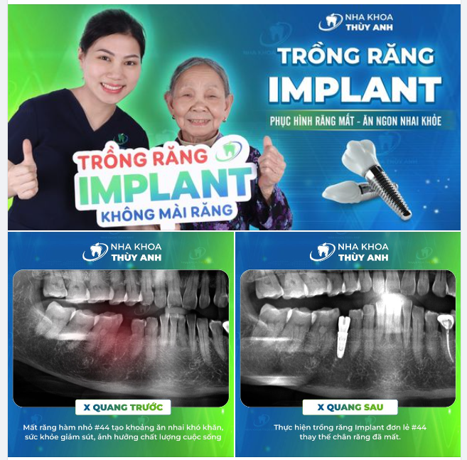 NGƯỜI CAO TUỔI CÓ THỂ TRỒNG RĂNG IMPLANT KHÔNG