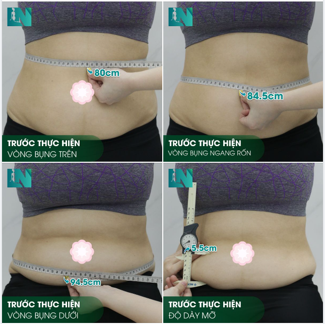 HÌNH ẢNH TRƯỚC KHI THỰC HIỆN HÚT MỠ TẠO DÁNG BỤNG - EO - HÔNG CỦA CHỊ KHÁCH VIỆT KIỀU CANADA SINH NĂM 1978