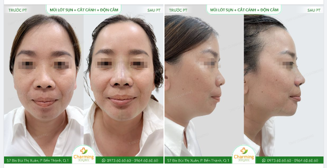 Không phải chỉ những loại hình liên quan đến mũi mới có thể thực hiện kết hợp.