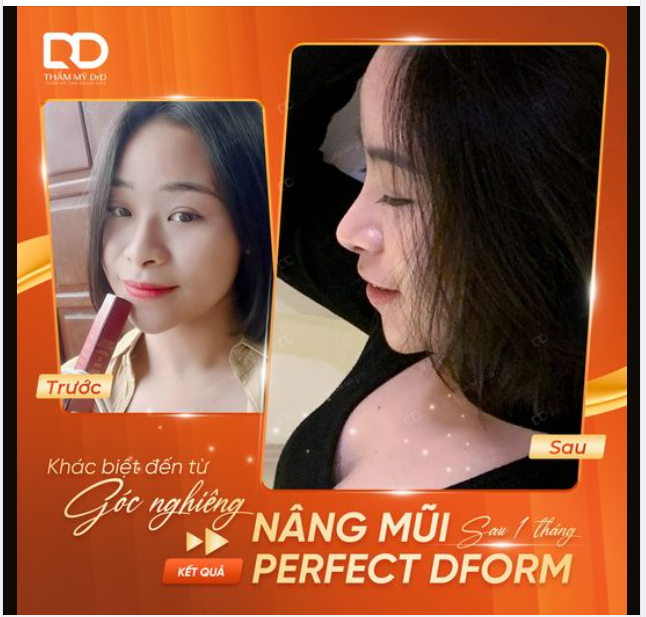 KHÁC BIỆT ĐẾN TỪ GÓC NGHIÊNG. NÂNG MŨI PERFECT DFORM SAU 1 THÁNG THỰC HIỆN