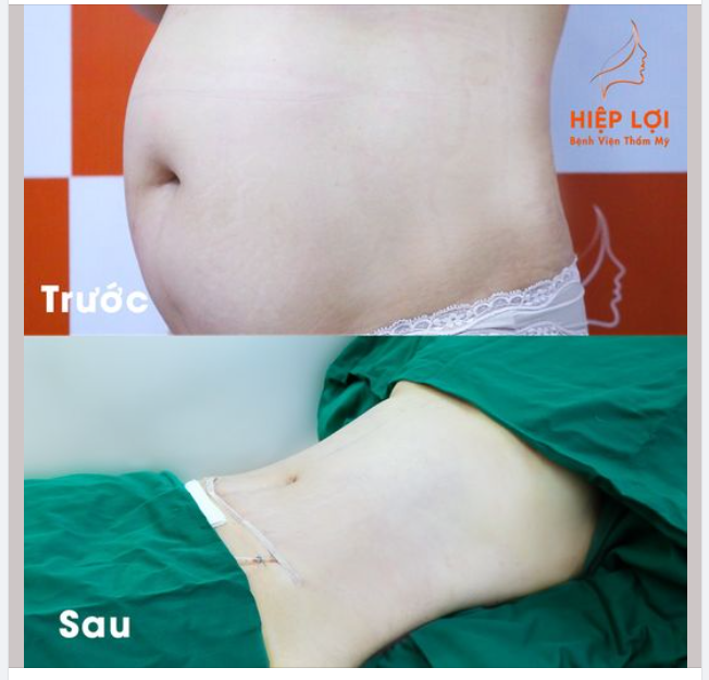Các phương pháp hút mỡ công nghệ cũ hoạt động dựa trên việc đốt nóng laser, cắt vụn mỡ bằng dao để phá huỷ mỡ thừa làm TỔN THƯƠNG đến các mô xung quanh.