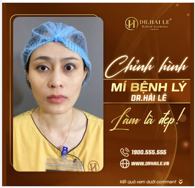 Chỉnh hình mí bệnh lý Dr Hải Lê - Làm là đẹp
