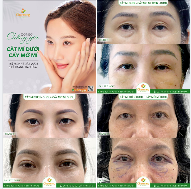 KHÁM PHÁ CÁC PHƯƠNG PHÁP TRẺ HÓA MÍ MẮT DƯỚI - CẮT MÍ VÀ CẤY RÃNH HÕM MÍ DƯỚI