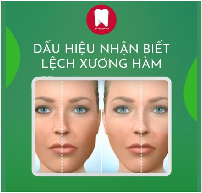 DẤU HIỆU NHẬN BIẾT HÀM BỊ LỆCH