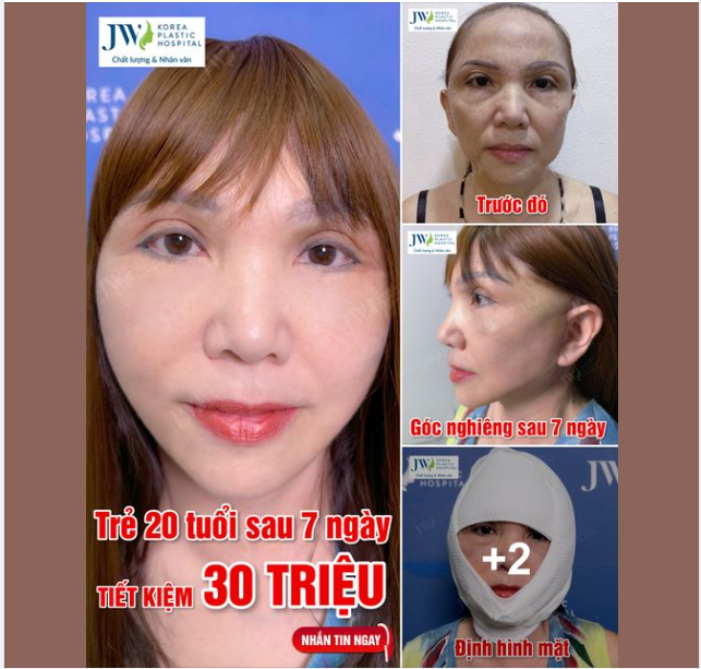 Việt kiều Canada U70 HỒI XUÂN 20 TUỔI nhờ Combo Căng da mặt Smas + Treo chân mày + Trẻ hoá mắt