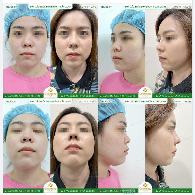 Đôi khi chỉ cần thay đổi một tý ở chiếc mũi là nhan sắc của bạn như được nâng cấp lên gấp nhiều lần đó nha