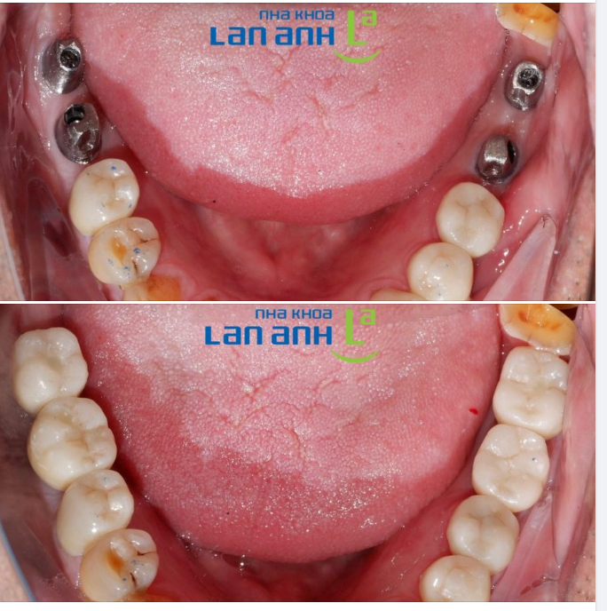 Phục hình Implant cho những răng bị mất và chịu lực nhai lớn cho khách hàng đã có tuổi.