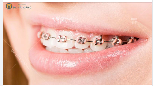 NIỀNG RĂNG 1 HÀM CÓ ĐƯỢC KHÔNG