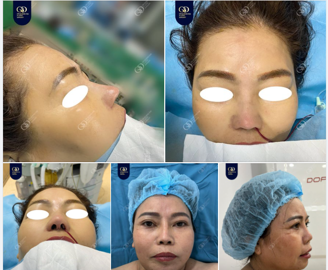 TÁI SINH MŨI MỚI