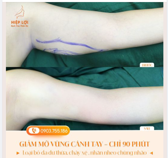 Sử dụng công nghệ tia nước Body Jet giải quyết tình trạng da dữ, ngấn mỡ, lấy lại bắp tay thon goc, săn chắc