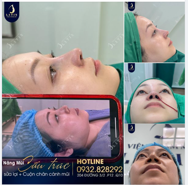 Động lực nào giúp chị khách Việt kiều Úc về Việt Nam sửa mũi