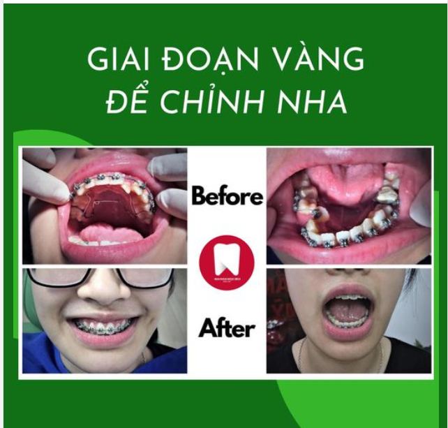 NIỀNG RĂNG - HÀNH TRANG TỰ TIN CHO CON