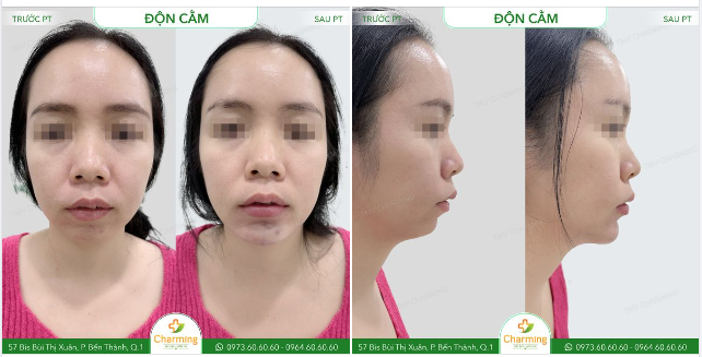 Mọi người có tin rằng chỉ với phương pháp độn cằm cũng có thể khiến cả gương mặt của một người thay đổi không?