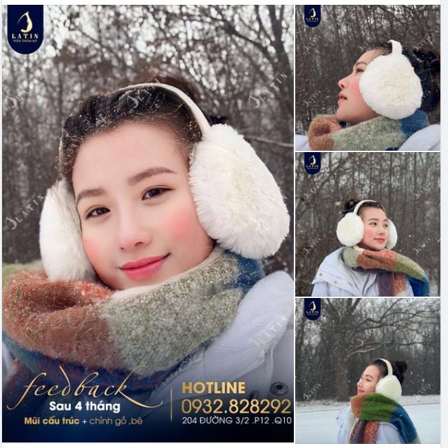 Sau 4 tháng nâng mũi, em gái luôn xinh đẹp và tự tin, bất chấp cái giá lạnh của phương trời Âu xa xôi.