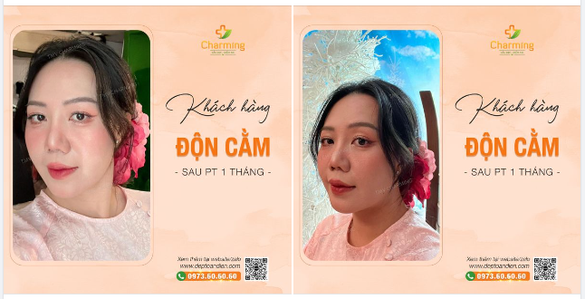 Em cười là bởi em vui. Em vui là bởi có cằm V-line