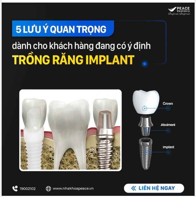 TRỒNG RĂNG IMPLANT