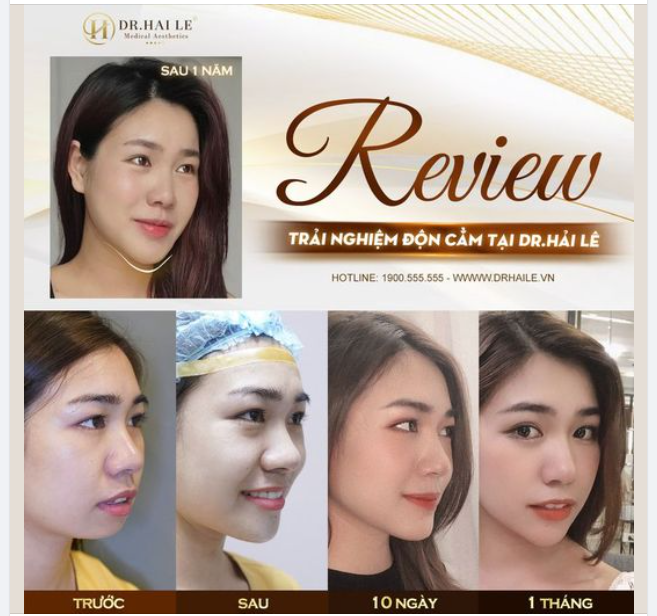 Review trải nghiệm độn cằm tại Dr Hải Lê