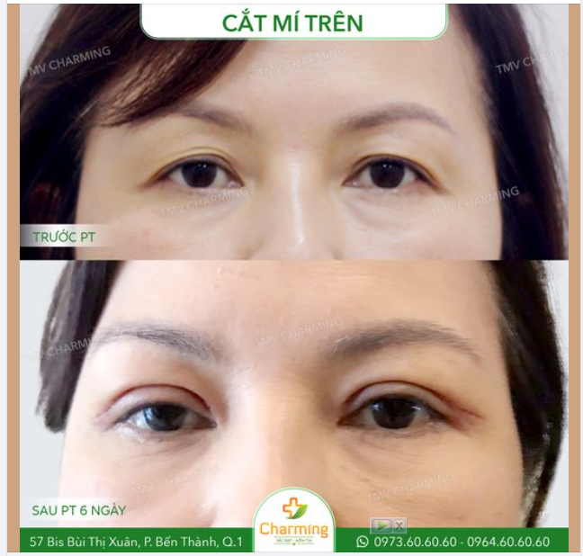 Mí sụp bây giờ đã là chuyện nhỏ khi đã có phương pháp cắt mí trên.