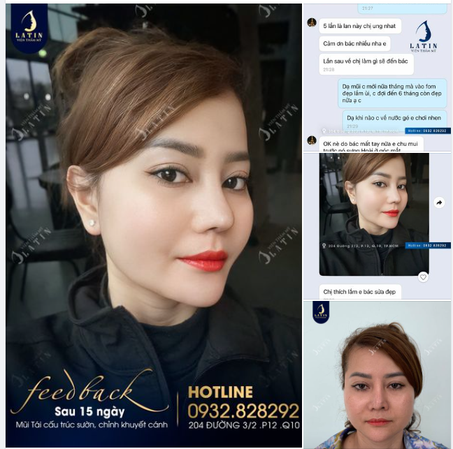 Feedback mũi tái cấu trúc sụn sườn 15 ngày của chị khách mê quá ạ