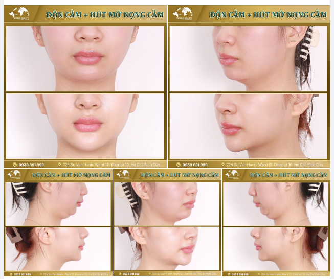 Khôi phục nét đẹp thanh tú cho gương mặt nhanh chóng chỉ với bộ đôi phẫu thuật Độn cằm Surgiform+ Hút mỡ nọng cằm